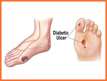 Diabetic-Foot-Treatment